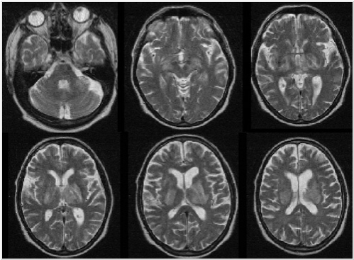  Нейросеть лучше врачей диагностировала рак мозга по снимкам МРТ [1]