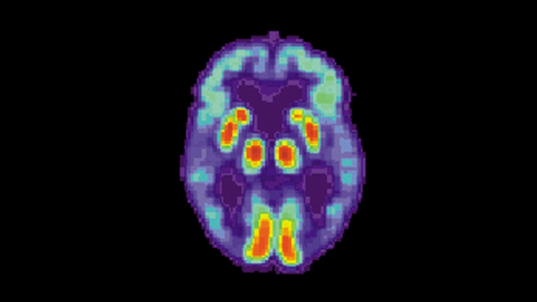Искусственный интеллект научился находить болезнь Альцгеймера в мозге за 6 лет до диагноза