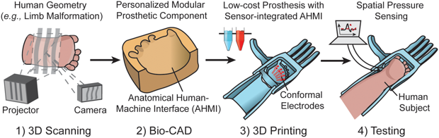 На 3D-принтере распечатали персонализированный протез для пациента с пороком развития кисти [2]