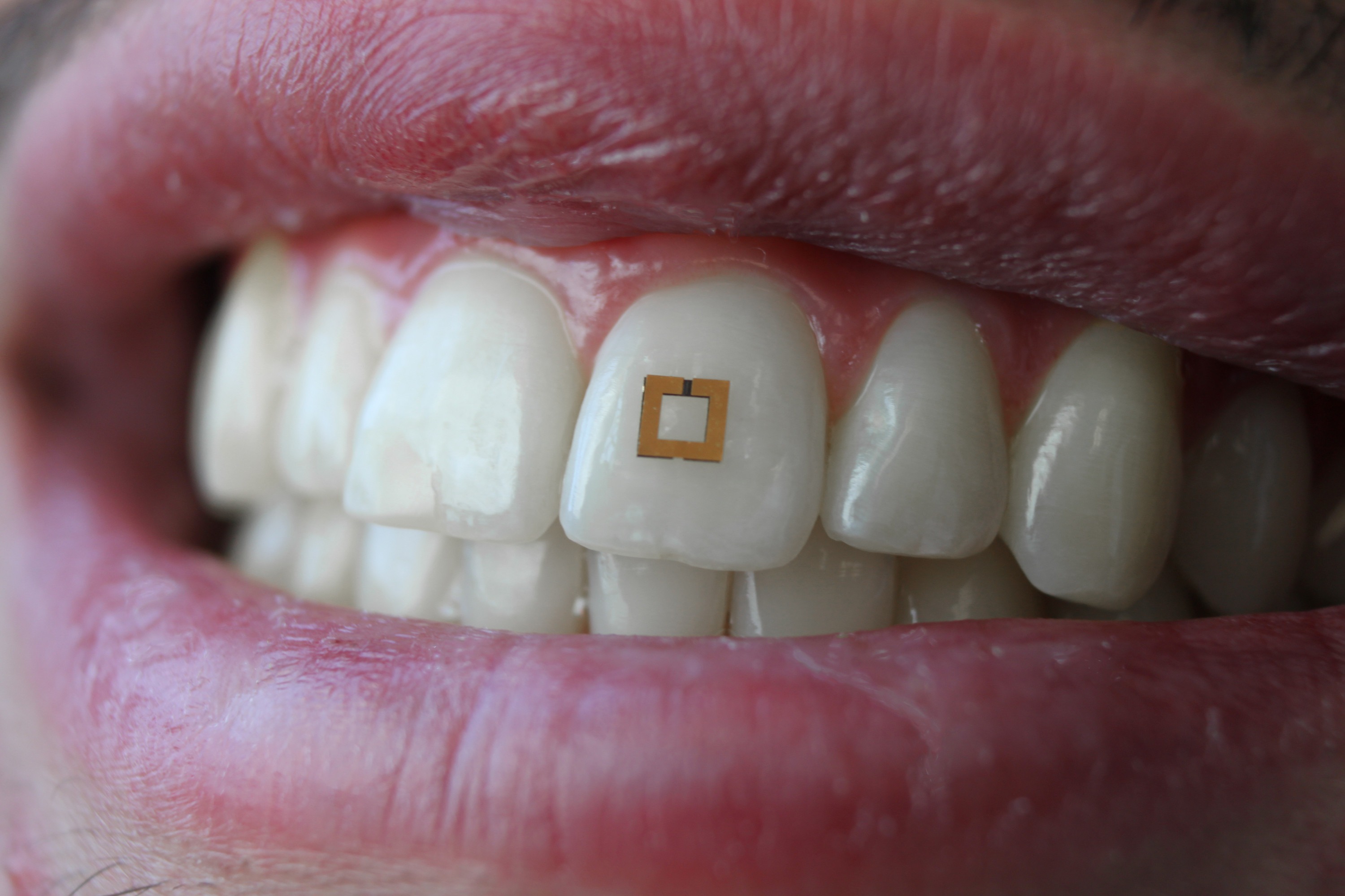 Новый уровень телемедицины: сенсоры на зубах, умные линзы и помощник для больных Альцгеймером [1]