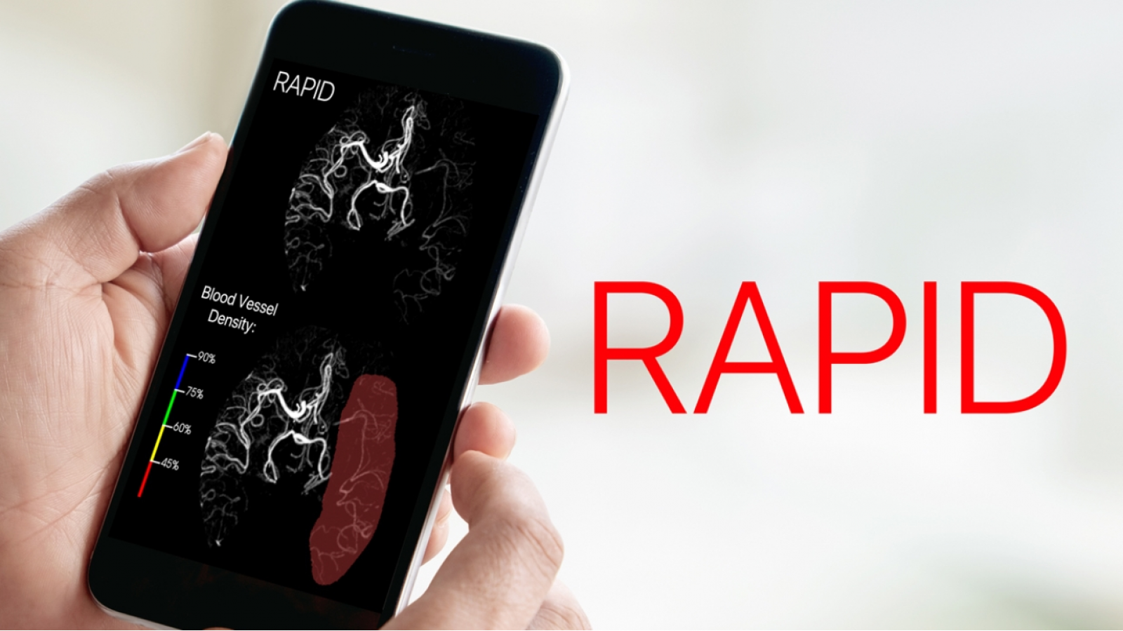 AI-платформа RAPID допущена для определения пациентов, которым показана эндоваскулярная тромбэктомия [1]