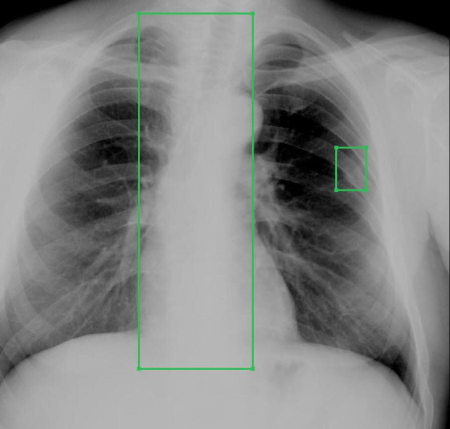 «Третье мнение» объявляет о запуске в тестовом режиме сервиса по распознанию рентгенограмм грудной клетки.  [1]