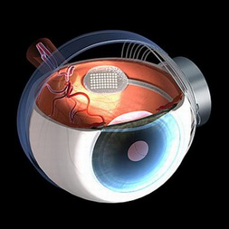 Бионический глаз. Первая операция по имплантации сетчатки, выполненная в России [6]