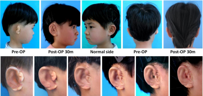 Китайцы вырастили детям новые уши из их собственных клеток [2]