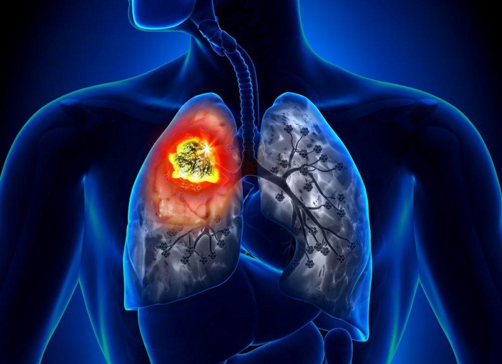 Медики назвали три основные причины развития рака легких